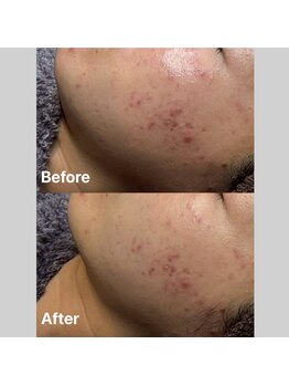 ヴィヴ フォー アール(VIV for R)/赤ニキビのお悩み改善 20代女性