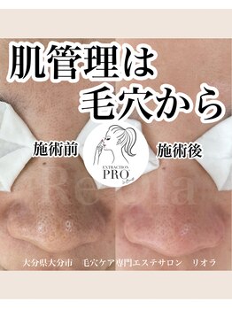 ニュートラル(neutral)/毛穴エクストラクションプロ大分