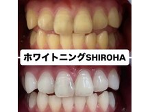 シロハ(SHIROHA)/セルフホワイトニング/天王寺