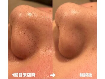 モアトゥインクル 東広島西条店(MORE twinkle)の写真/＼すっぴん美肌へ♪／毛穴汚れしっかり除去し、化粧ノリ抜群★肌触りに驚き!ツヤ感・透明感あふれるお肌に!