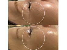 ミヨン(Miyong)/白玉水光肌（LDM）/くすみ改善