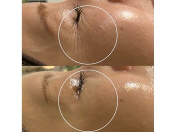 ミヨン(Miyong)/白玉水光肌(LDM)/くすみ改善