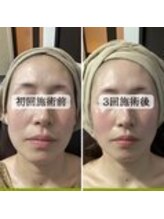 ル ボヌール 伊那店(le bonheur)/シミケア　3回目