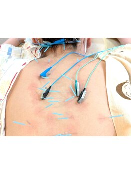 鍼灸施術を受けたい