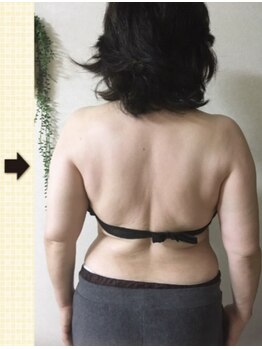 ノットノット 自由が丘(Not Knot)/２.ブライダル 上半身集中施術後