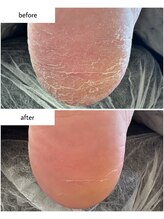 ケアプラス(care plus)/足裏角質ケア