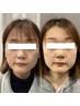 顔の歪みエラ張り顎関節の痛み改善美顔鍼灸整体9900→4400円（鍼無しでも可）