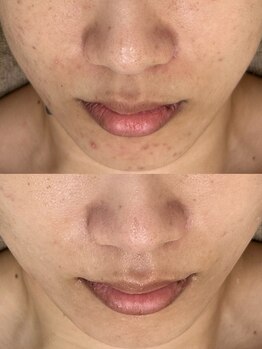 レイニゲン(H/Reinigen)/