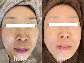 アリス(ALICE)/くすみ改善プラセンタ