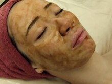 マールム(MALUM)/ハーブピーリング