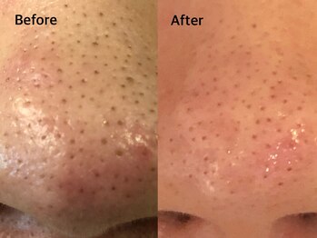 アンベリール(Embellir)/毛穴洗浄beforeafter