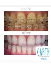 ホワイトニングショップ 福岡姪浜店/【ビフォーアフター】美白
