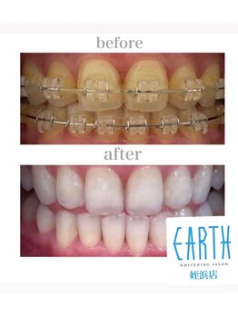 ホワイトニングショップ 福岡姪浜店/【ビフォーアフター】美白