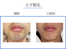 エクシアホワイトニング 岡崎店/メンズOK◇濃いヒゲの脱毛にも！