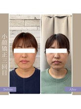 キアラ(chiara)/小顔矯正3回目
