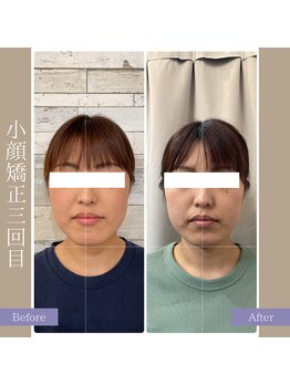 キアラ(chiara)/小顔矯正3回目
