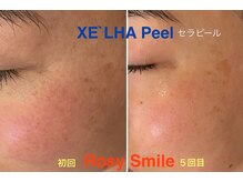 ロージースマイル(Rosy smile)の雰囲気（韓国　XE`LHA Peel（セラピール）キメ・潤いUP・くすみ）