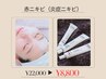 【赤ニキビケア】ビタミンAニードルピール×炭酸ガスパック¥22,000→¥8,800
