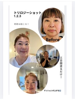 ジェーピーユキノ(jp.yukino)の写真/お家で3日間塗っただけで別人になってしまった！ほうれい線、たるみ、シワ、シミ、ニキビが気になる方へ