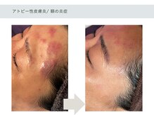 アーブル(Agreable)/赤み/乾燥/血行不良/疲労/肩凝り