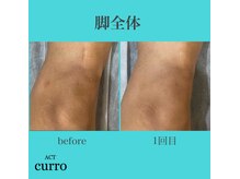 アクト クロ(ACT curro)/【脚全体】脱毛施術例