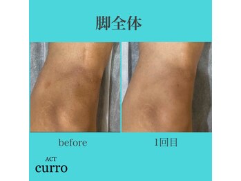 アクト クロ(ACT curro)/【脚全体】脱毛施術例