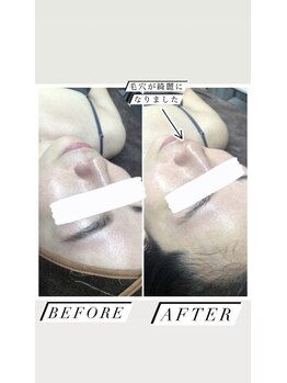 レチカ(Rechica)/ハーブピーリング