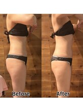 サラモ(Sa La Mo)/脂肪冷却　お腹