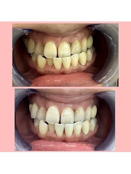 エクシア ホワイトニング 鶴岡店/ビフォーアフター