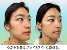 ナチュラルビューティーフェイス 横浜(NBF)/Before&After