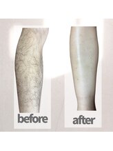 エイビー(ei-B)/【膝下脱毛】清潔感UP!