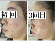 ホリシア 博多(HORISHIA)/ハーブピーリング/ニキビケア