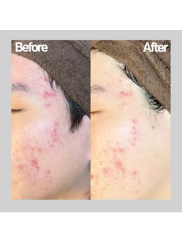 ヴィヴ フォー アール(VIV for R)/赤ニキビのお悩み改善 10代男性