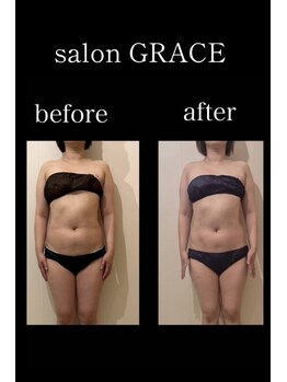 サロン グレイス(salon GRACE)/40代腹痩身