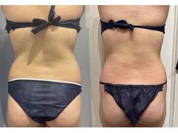 エイシスグロウ(asis glow.)/効果写真