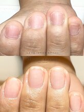 マリーロール 梅田店(Marie Laure)/自爪育成/深爪矯正/ネイルケア