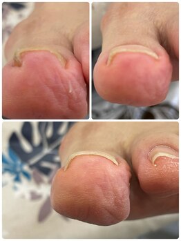 ネイルサロン ナチュラルキュア(Natural Cure)/足の爪のお悩み