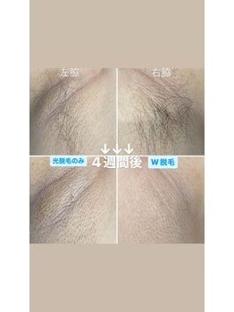 エピシアドットエヌ(epicia.N)/ダブル脱毛