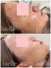 ビエル(Bielle)/痛みが怖い方にオススメ