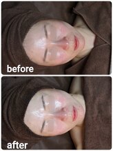 ウララ(ulala)/ララ初回ビフォアフ