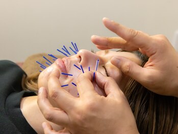 ボニー(Bonnie)/【美容鍼灸】