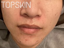 トップスキン 新宿(TOPSKIN)/ニキビ肌/敏感肌/赤ら顔にも