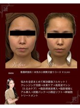 リノン(LIINON)/看護師施術！本気の小顔贅沢盛り