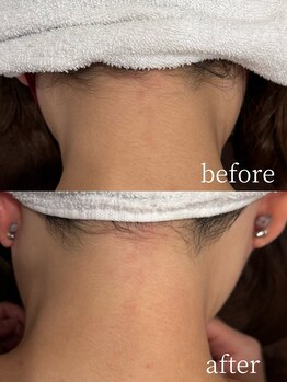 トータルビューティー ミミ(Total Beauty mimi)/美肌になりながら脱毛できる！！