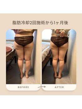 トータルサロン ヴィータ(VITA.)/痩身/脂肪冷却♪