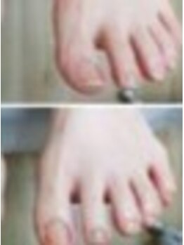 リゼラアンドコー 名古屋栄店【フットケア/巻き爪/足裏角質/爪トラブル】/