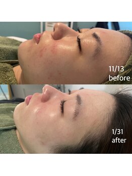 ベル 静岡(Belle)/静岡/ハーブピーリング/毛穴