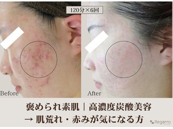 レガロビューティクリエイションズ桜川店/高濃度炭酸肌質改善フェイシャル