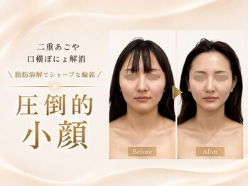 エン 橿原店(en)の写真/丸顔・二重あご・口横のもたつきに。気になる脂肪を狙ってケアし、すっきりシャープなフェイスラインへ。