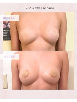 ナナイロ(nanairo)の写真/【切らない新発想バストケア】脂肪増殖ケアでふっくら自然に♪理想のボリューム＆美バストラインへ